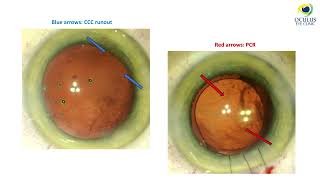 Panoptix IOL implantation in the setting of large PCR  Videocattarattarefrattiva Congress 2024 [upl. by Kirsten]