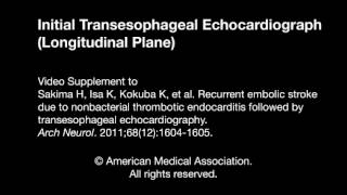 Recurrent Embolic Stroke Due to Nonbacterial Thrombotic Endocarditis Followed by Transesophageal Ech [upl. by Nazay313]