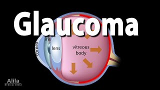 Development of Glaucoma Animation Open Angle vs Angle Closure Glaucoma [upl. by Nylak]