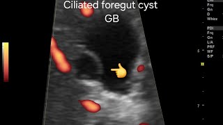 Ciliated foregut cyst of gallbladder very rare case ultrasound amp color Doppler overview [upl. by Frame]