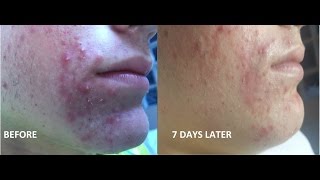 Ángels Acne Treatment 1 [upl. by Cousins7]