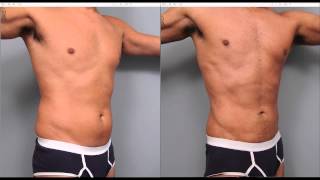 The Benefits of Liposuction for Men  Dr Sterry Explains [upl. by Nednarb]