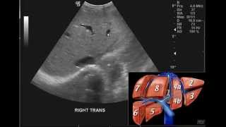 Introduction to the interpretation of Abdominal Ultrasound [upl. by Sena529]