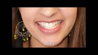 Invisalign for Adults A Better Way to a Straighter Smile [upl. by Euqinorev587]