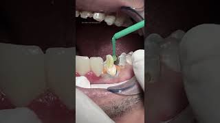 Composite with fiber post dentist [upl. by Yattirb330]