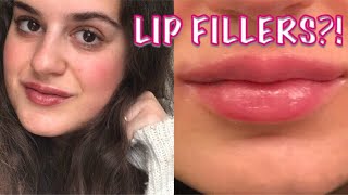 LIP INJECTIONS VLOG l My Experience Getting Lip Fillers [upl. by Jerry]