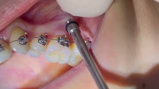 IZC screw Infra Zygomatic Crest TAD insertion of IZE mini screw IZC orthodontic mini implant [upl. by Patnode]