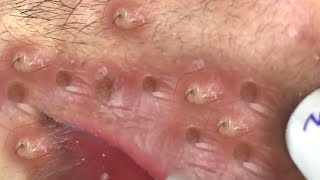 Clean Giant Blackheads on on the Lips [upl. by Ode]