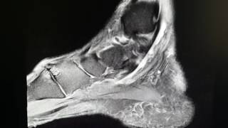 Flexor Hallucis Longus Tendon Rupture as seen on MRI [upl. by Sosanna]