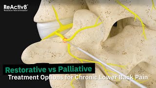 Restorative vs Palliative  Treatment Options for Chronic Lower Back Pain [upl. by Aniar]