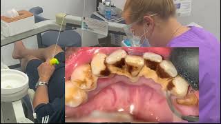 Dental cleaning  scaling teeth removing smoker’s tartar [upl. by Shelley]