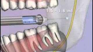 Medical Videos Malamed s Local Anesthesia 10 Mandibular Injections flv [upl. by Tedda]