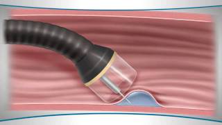 Learn About an Endoscopic Mucosal Resection [upl. by Ecirum]