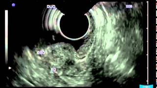 Type 1 Sphincter of Oddi Dysfunction due to Chronic Opium Addiction [upl. by Emyaj]