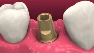 Restoring dental implants video BioHorizons [upl. by Nonie]