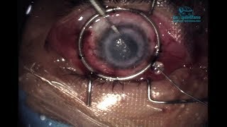 Transplante de cornea Cornea transplant [upl. by Alleoj]