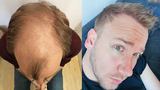 Hair Transplant Before and After  Month by Month results Elithair 8 [upl. by Atteoj56]