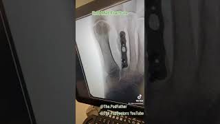 podiatry fracture bone operation surgery ouch xray [upl. by Suirad]