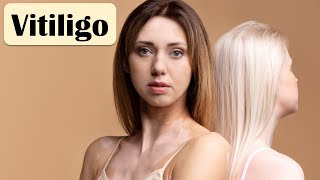 Vitiligo  Causes Pathogenesis Signs amp Symptoms And Treatment [upl. by Etterraj614]