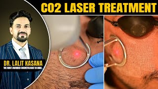 co2 fractional  laser treatment for acne scars  DrLalit Kasana [upl. by Alleen900]