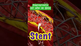 Angioplasty angioplasty heartattack facts ytshortsindia science [upl. by Tolkan]