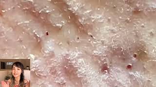 BEST BLACKHEAD amp CYST POPPING 2024 [upl. by Jaclyn]