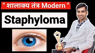 Staphyloma In Hindi  Shalakya Tantra  Ophthalmology  Staphyloma lecture  BAMS  Easy Notes 😍 [upl. by Polloch]