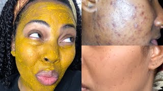 I Tried DIY Tumeric Mask For 3 Days And This Happened My Skin Feels like a Baby’s Butt [upl. by Haerle]