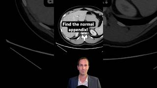 Abdominal CT Tutorials  Find the Normal Appendix [upl. by Archibald]