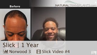 Hair Growth After 2nd Hair Transplant Baldness Cure for Black Men  Dr Blumenthal Slick [upl. by Anauq]