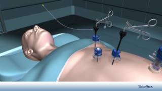 Colecistectomía Laparoscópica con el Sistema Weck® Hemolock® Auto Endo 5® [upl. by Conny]