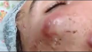 Big Acne Pus on face pop out Really hurt and terrified [upl. by Llenwahs]