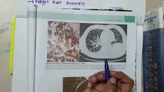 Metastasis Lung Disease mp4 [upl. by Anilyx177]