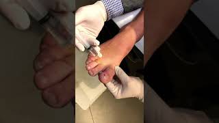 How to Perform a HBlock to Numb a Toe with Local Anaesthetic for Ingrown Nails [upl. by Larissa]