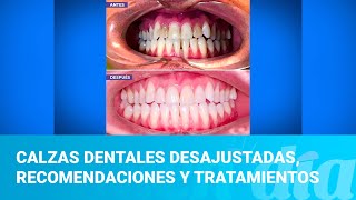 Calzas dentales desajustadas consejos recomendaciones y tratamientos [upl. by Richelle]