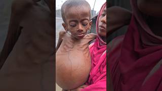 kwashiorkor  क्वाशियोकोर  Protein Deficiency  malnutrition [upl. by Stralka]