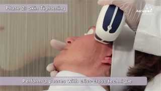 MeDioStar NeXT PRO  Training video for skin rejuvenation and whitening from Asclepion [upl. by Ecidnacal]