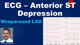 ECG – Anterior ST Depression Includes a discussion on wraparound LAD [upl. by Dauf]