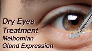 Dry Eyes Treatment with Meibomian Gland Expression MGD [upl. by Sophi]