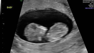 11 Weeks 2 Days Fetal Ultrasound  Baby Jumps [upl. by Leboff137]