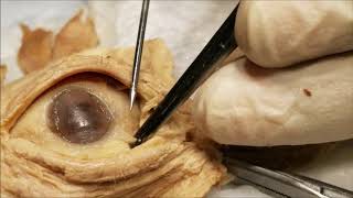 Exenterated Eyeball 1 – Conjunctival Dissection with Clinical Aspects – Sanjoy Sanyal [upl. by Eirruc]