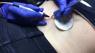 Skin Tag Removal using electrolysis advanced cosmetic procedures [upl. by Aelc351]