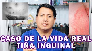 COMO ELIMINAR LA TIÑA INGUINAL [upl. by Elleinnod488]