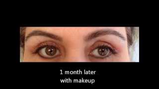 Blepharoplasty Upper eyelid lift surgery  recovery story [upl. by Eirrehs]