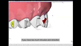 PIR protocol for CII div 2  procline intrude retract with Onyxceph [upl. by Regazzi803]