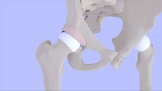 Femoroacetabular Impingement Syndrome [upl. by Kurr579]