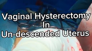 Vaginal Hysterectomy in Undescended uterus  Very important  Tips and Tricks  to make it Easy ⭐️⭐️ [upl. by Arihsa]