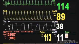 Bronchospasm 2  Patient Monitor [upl. by Duval]