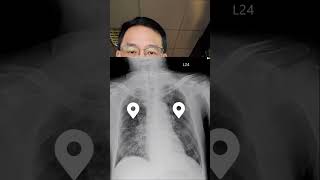 X光片判讀cystic lung ds [upl. by Yecrad]