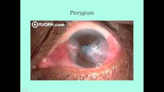 Other Conjunctival Disorders  CRASH Medical Review Series [upl. by Aihppa]